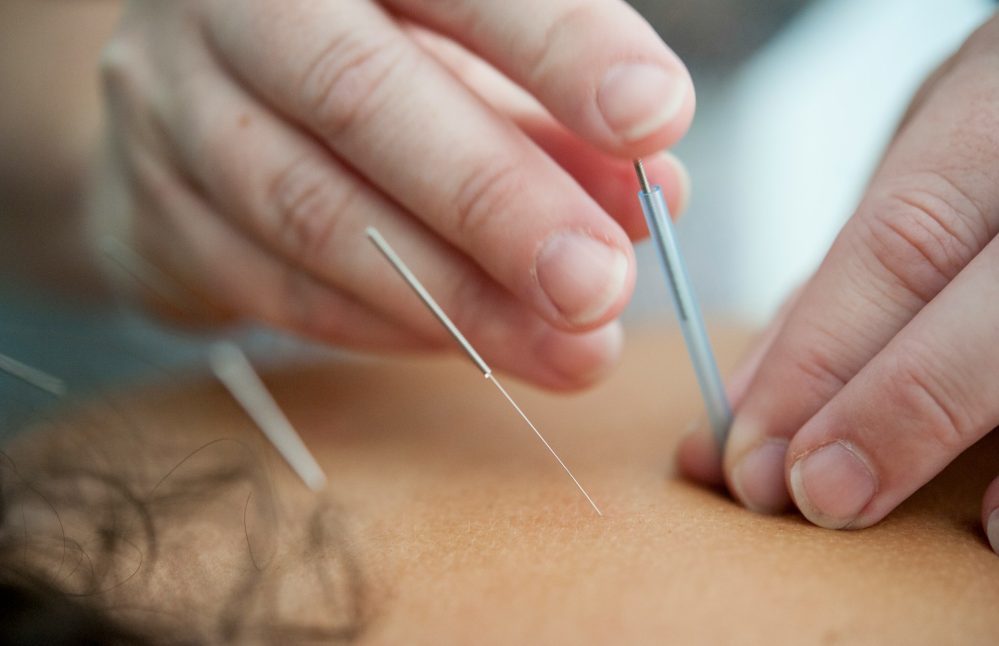 what-to-expect-from-acupuncture