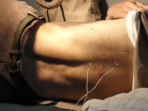 acupuncture-for-back-pain
